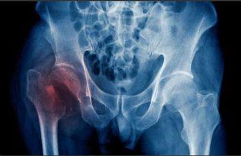 FRACTURE OSTEOPOROTIQUE
